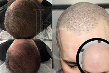 Saç Simülasyonu vs Saç Ekimi Karşılaştırması